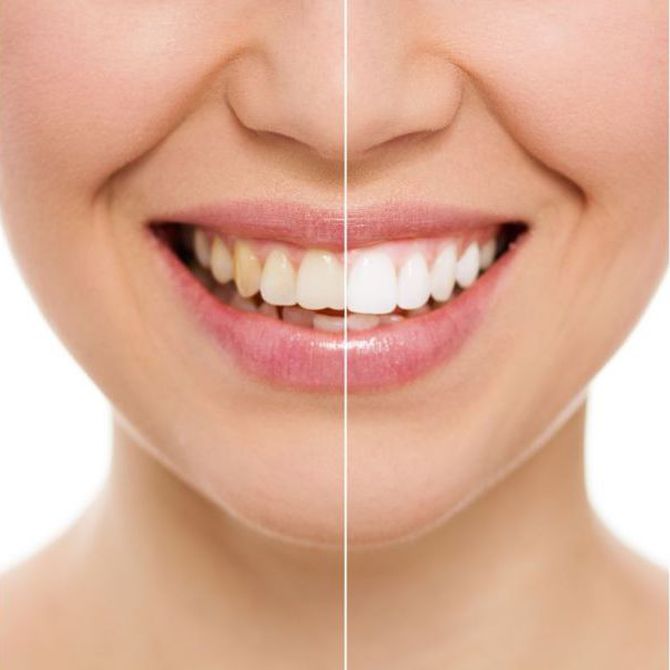 El blanqueamiento dental por fotoactivación